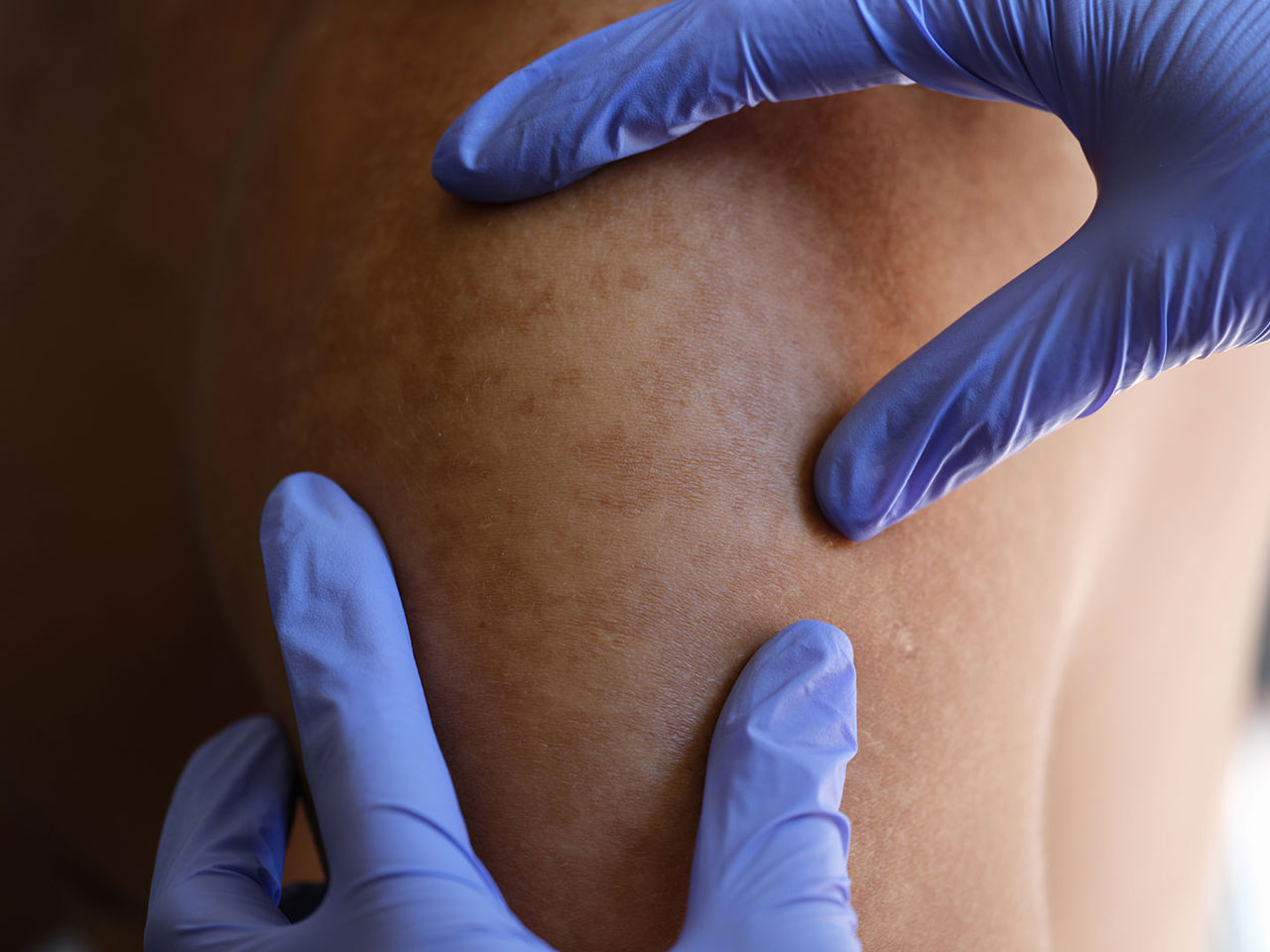 En læge der kigger på huden på en skulder // Foto: Colourbox