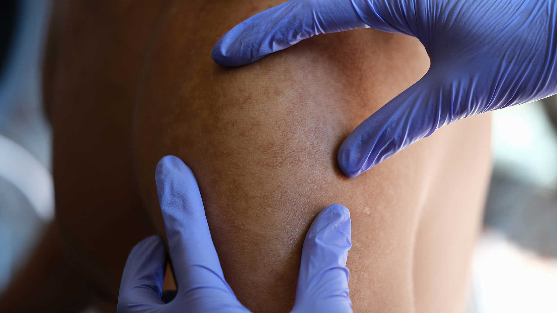 En læge der kigger på huden på en skulder // Foto: Colourbox